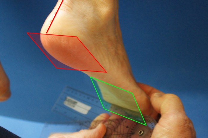 Foot and Foot Related Diagnosis